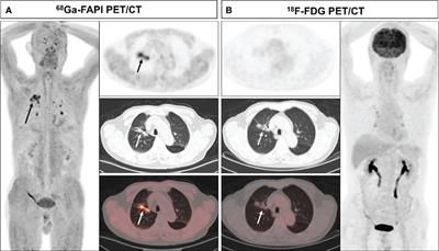 Comparison of 68Ga-FAPI and 18F-FDG PET/CT in the Evaluation of Patients With Newly Diagnosed Non-Small Cell Lung Cancer